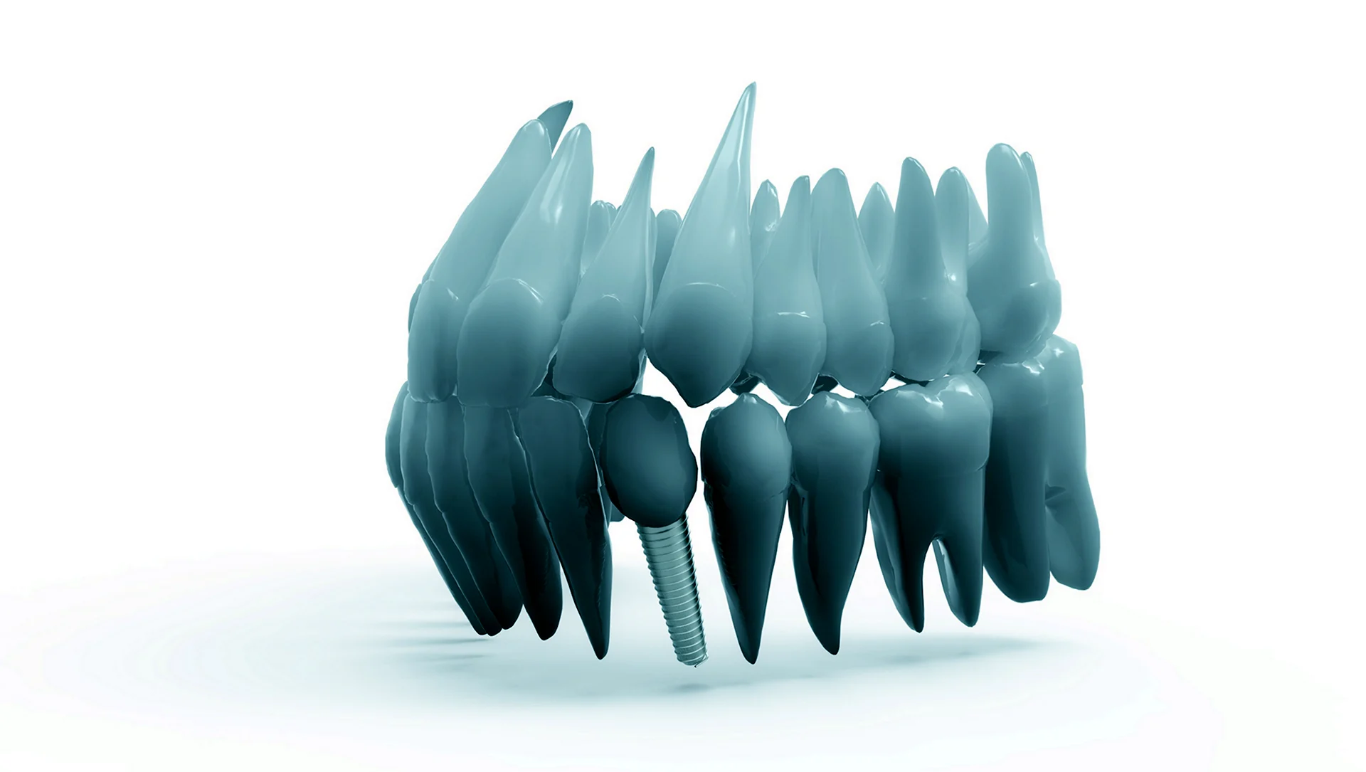 Имплант челюсти 3д принтер
